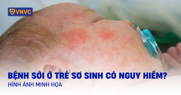 Chăm sóc bé sơ sinh bị sởi