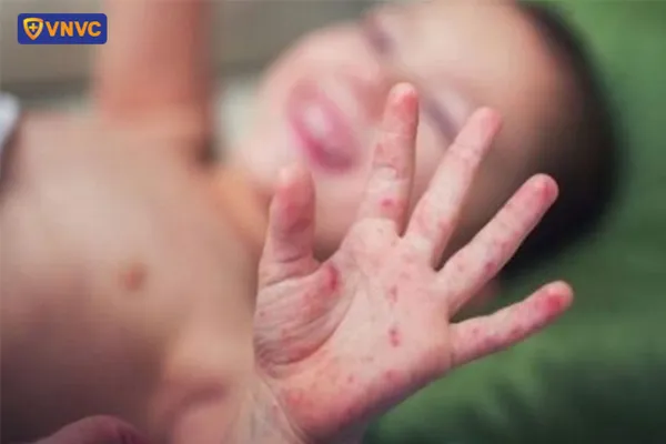 Hình ảnh sởi 3