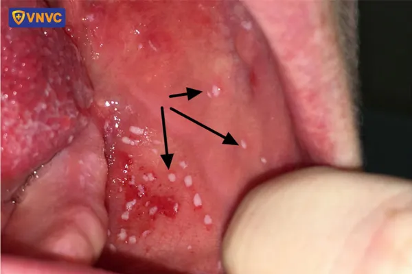 Hình ảnh sởi 5