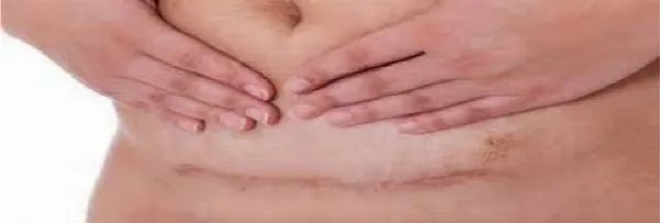 Vết mổ sau 2 tháng