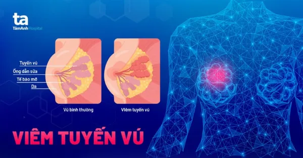 Viêm tuyến vú ở mẹ sau sinh
